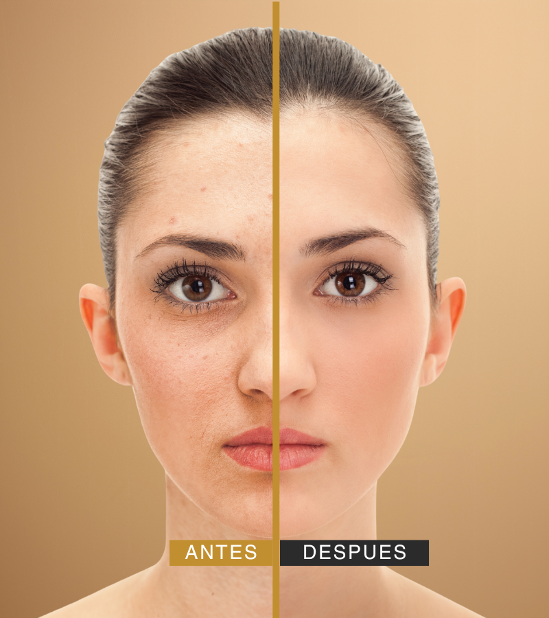 antes y despues con botox en valladolid