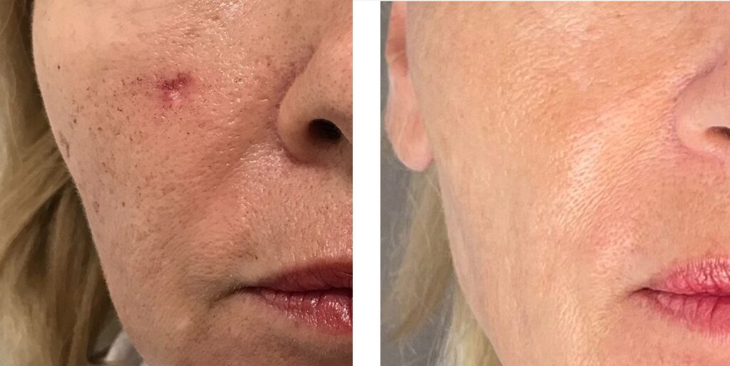 brillo y eliminada cicatriz por acne